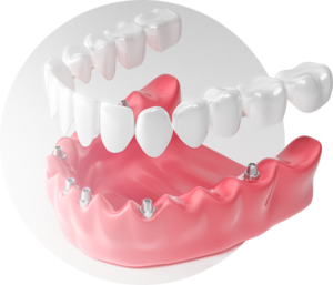 Технология All-on-4 зубы за день